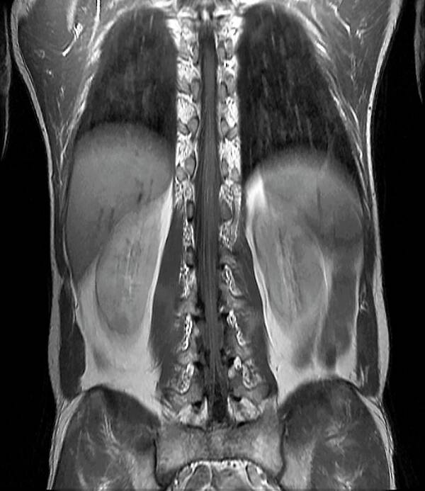 Black And White Poster featuring the photograph Normal Spinal Cord by Zephyr