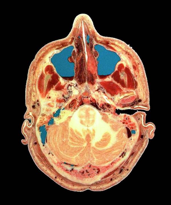 Brain Anatomy Poster featuring the photograph Visible Human Project: Sectioned Male Head by Mehau Kulyk/science Photo Library