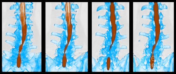 Osteophyte Poster featuring the photograph Spine, Ct Scan by Scott Camazine