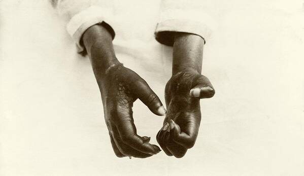 Leprosy Poster featuring the photograph Hands Disfigured By Leprosy by American Philosophical Society