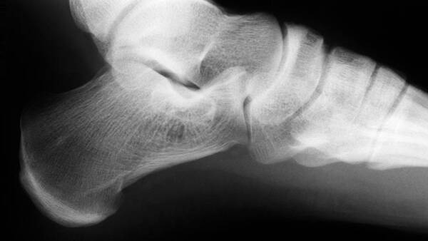 Ankle Poster featuring the photograph Ankle Joint, X-ray by Kaj R. Svensson