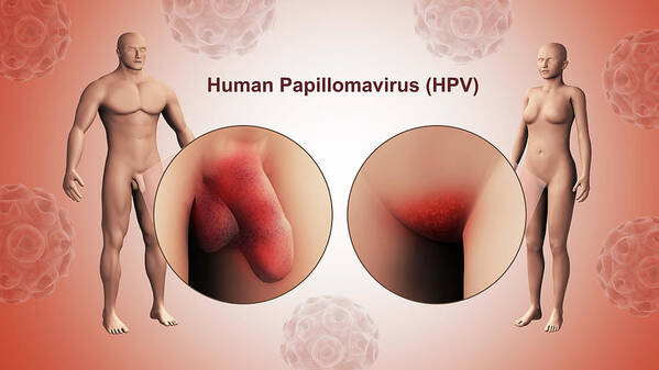 human papillomavirus infection poster larve parazite