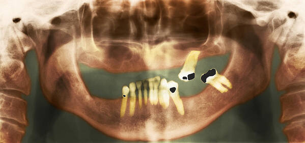 Teeth Poster featuring the photograph Loss Of Teeth, X-ray by 