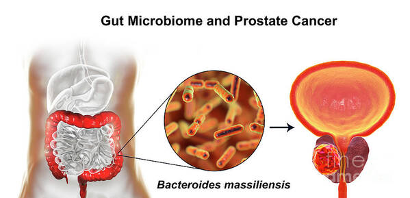 Dimensional Poster featuring the photograph Gut Microbiome And Prostate Cancer by Kateryna Kon/science Photo Library