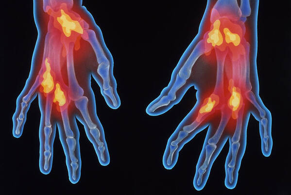 Aging Poster featuring the photograph X-ray Of Arthritic Hands #1 by Chris Bjornberg