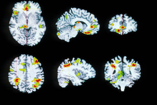 Obsessive Compulsive Disorder Poster featuring the photograph Brain Scan by Wellcome Dept. Of Cognitive Neurology/ Science Photo Library