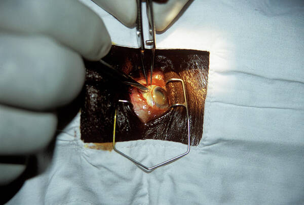 Cataract Poster featuring the photograph Cataract Surgery by Jason Kelvin/science Photo Library