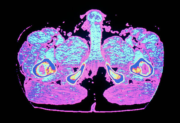 Thigh Poster featuring the photograph Coloured Computed Tomography Scan Of Erect Penis by Cnri/science Photo Library