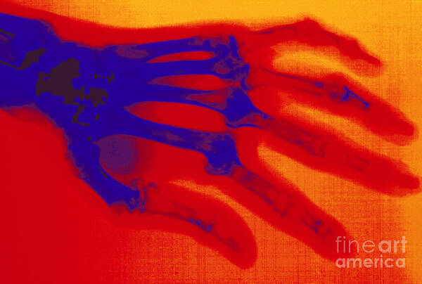 Arthritis Poster featuring the photograph X-ray Of Hand With Rheumatoid Arthritis by Scott Camazine