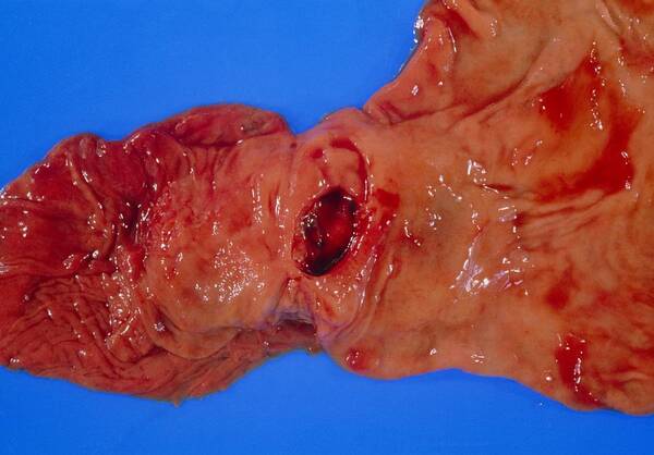 Gastric Ulcer Poster featuring the photograph Bleeding Gastric Ulcer In Excised Part Of Stomach by Dr. E. Walker