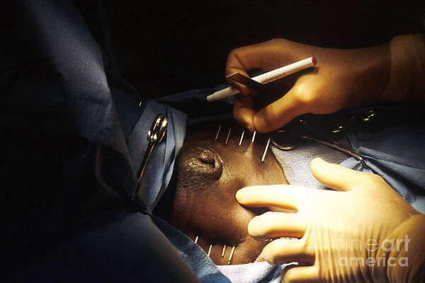 Surgical Procedure Poster featuring the photograph Iridium Seed Implantation by Photo Researchers