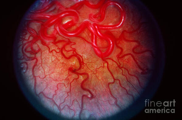 Blood Vessels Poster featuring the photograph Wyburn-mason Syndrome #1 by Science Source