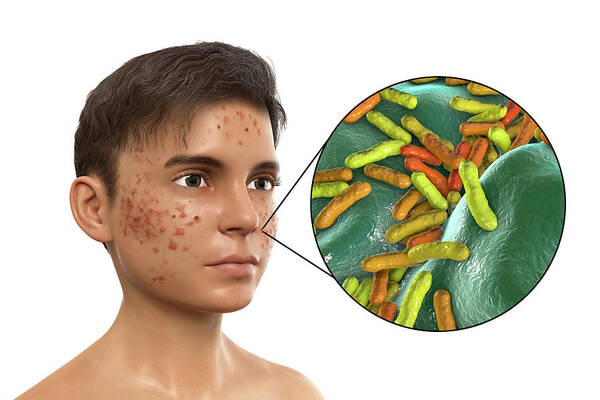 Abnormal Poster featuring the photograph Acne On A Teenage Boys Face #1 by Kateryna Kon