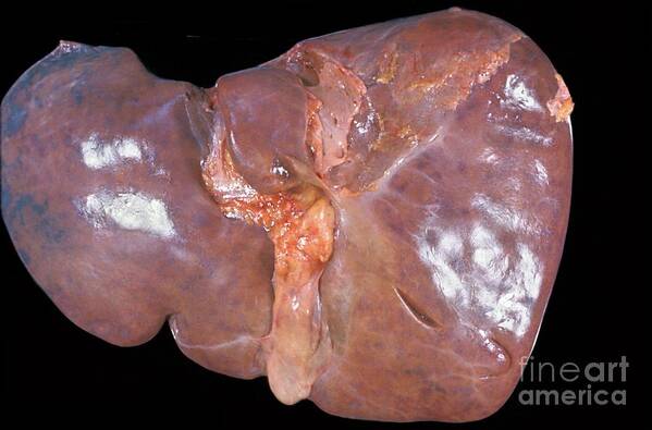 Medicine Poster featuring the photograph Unhealthy Human Liver #2 by Jose Calvo / Science Photo Library
