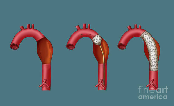 Aortic Stent Graft Poster featuring the photograph Aortic Aneurysm Stent, Illustration #1 by Monica Schroeder