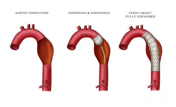 Aortic Stent Graft Poster featuring the photograph Aortic Aneurysm Stent, Illustration by Monica Schroeder