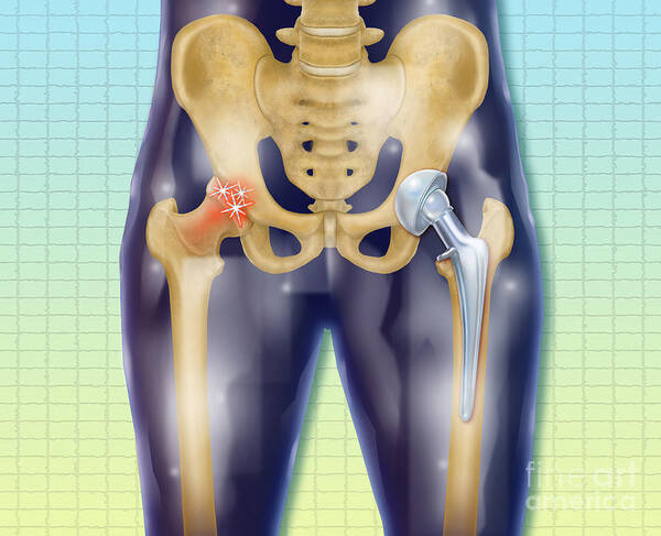 Science Poster featuring the photograph Arthritic And Replacement Hip #1 by Chris Bjornberg