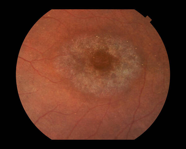 Abnormal Poster featuring the photograph Bulls-eye Retinopathy #1 by Paul Whitten