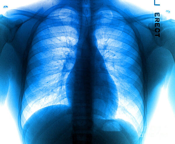 Medical Poster featuring the photograph Chest X-ray by Living Art Enterprises, LLC