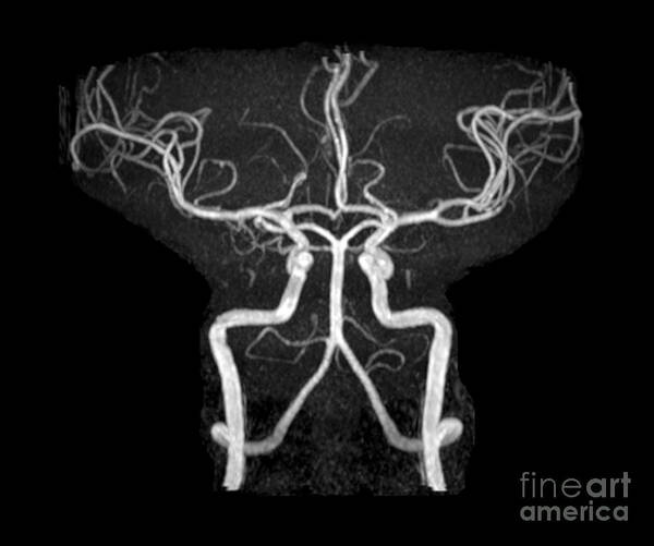 Intracranial Mra Poster featuring the photograph Normal Intracranial Mra by Living Art Enterprises