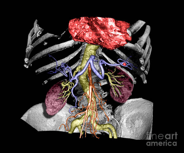Computerized Axial Tomography Poster featuring the photograph Splenic Artery Aneurysm by Living Art Enterprises, LLC