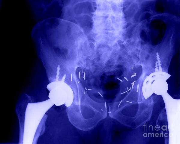 Surgical Poster featuring the photograph Double Hip Replacement #2 by Ted Kinsman