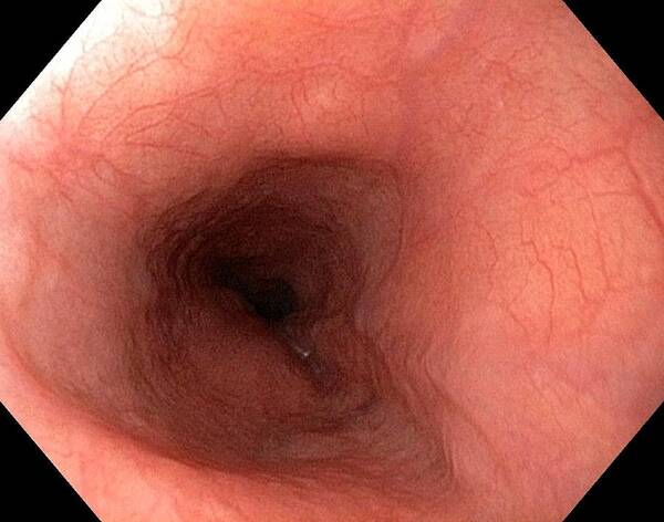 Endoscopic View Poster featuring the photograph Healthy Oesophagus #2 by Gastrolab