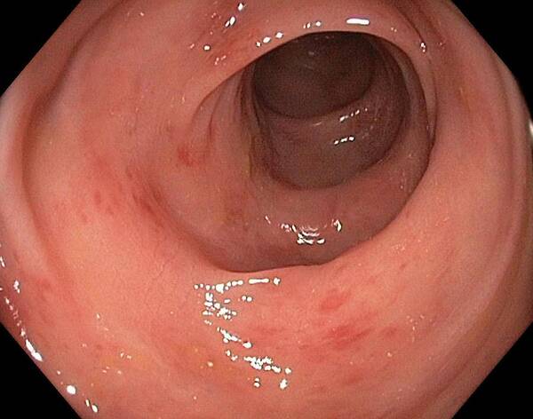 Endoscope View Poster featuring the photograph Inflamed Colon From Viral Gastroenteritis by Gastrolab
