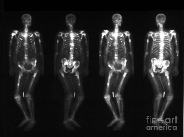 Spine Poster featuring the photograph Bone Scan Showing Multiple Metastases #4 by Scott Camazine