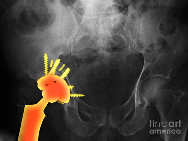 Science Poster featuring the photograph Dislocated Hip Replacement by Scott Camazine