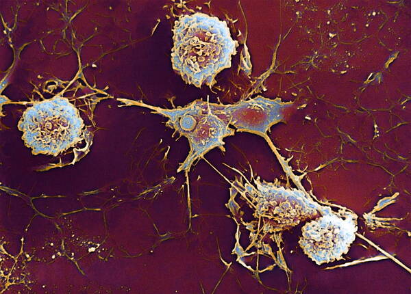 Microglial Cell Poster featuring the photograph Multiple Sclerosis, Sem #3 by Dr John Zajicek