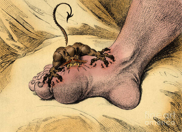 18th Century Poster featuring the photograph The Gout by Science Source