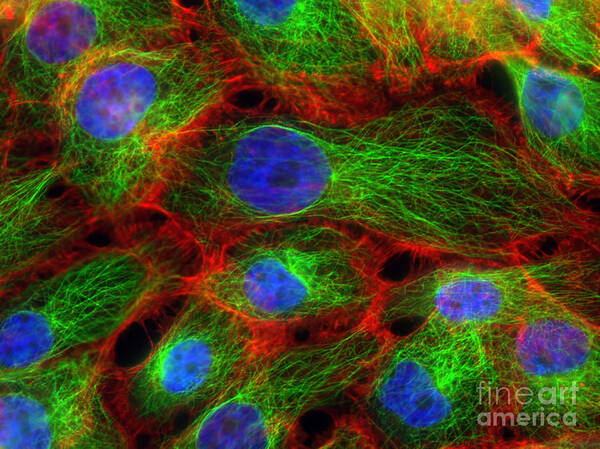 Science Poster featuring the photograph Breast Cancer Cells, Fm #6 by Science Source
