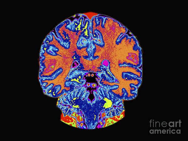 Mri Poster featuring the photograph Coronal View Mri Of Normal Brain by Medical Body Scans