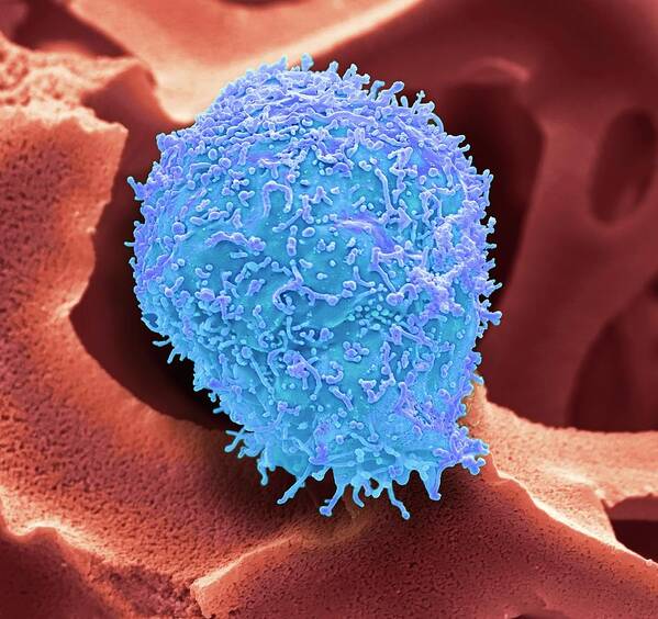 3d Poster featuring the photograph Cervical Cancer Cell #5 by Steve Gschmeissner