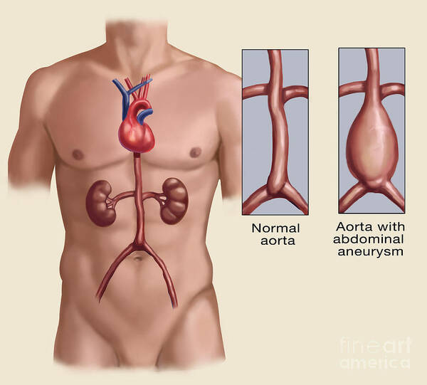 Science Poster featuring the photograph Abdominal Aneurysm by Spencer Sutton