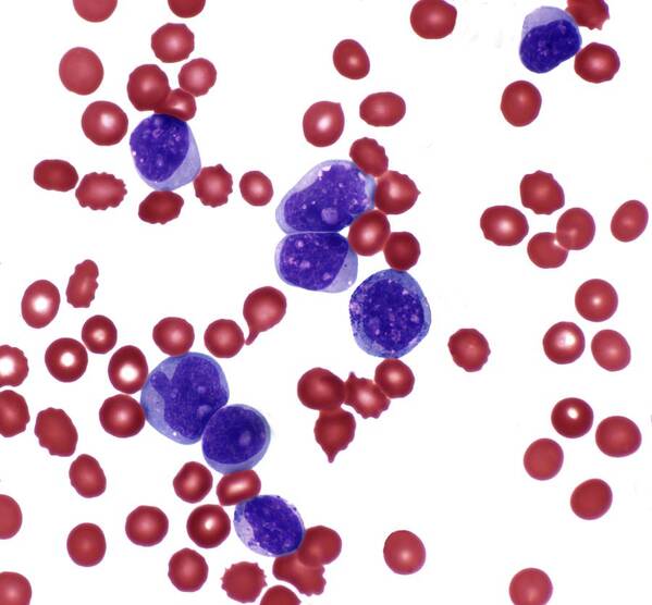 Abnormal Poster featuring the photograph Acute Myeloid Leukemia by Steve Gschmeissner/science Photo Library