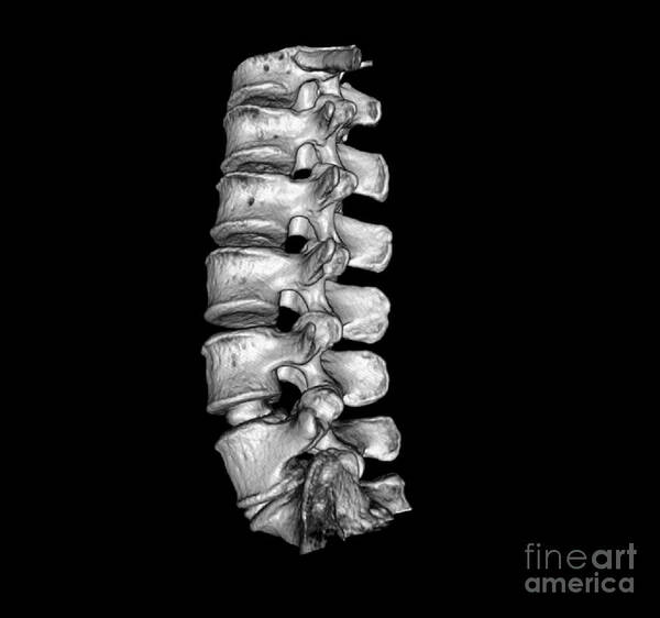 Ct Discogram Poster featuring the photograph Lumbar Spine by Living Art Enterprises, LLC