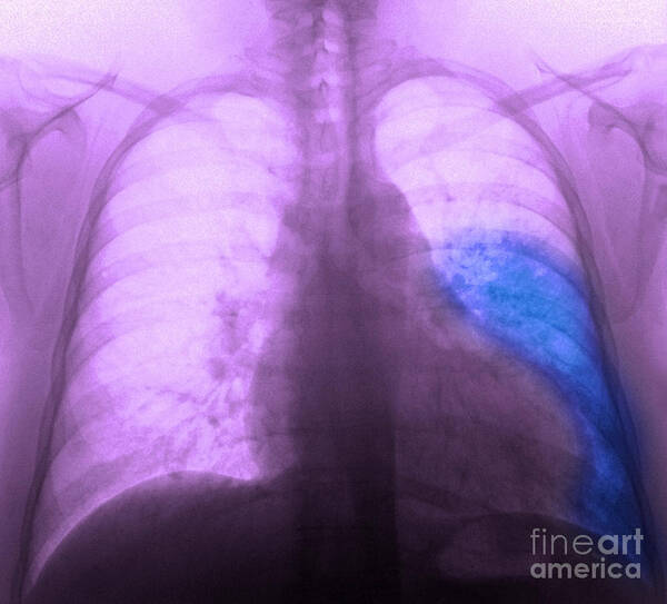 X Ray Poster featuring the photograph Pneumonia, X Ray by Scott Camazine
