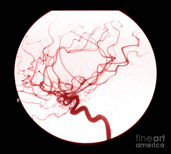 Cerebral Angiogram Poster featuring the photograph Internal Carotid Cerebral Angiogram #2 by Medical Body Scans