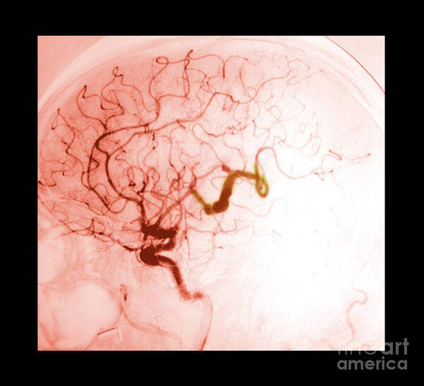 Abnormal Brain Poster featuring the photograph Serpentine Aneurysm #3 by Medical Body Scans
