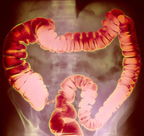 Rectum Poster featuring the photograph Large Intestine, X-ray by Cnri