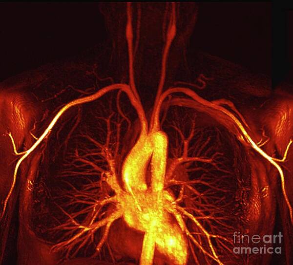 Magnetic Resonance Angiography Poster featuring the photograph Heart And Torso Blood Vessels #1 by Zephyr/science Photo Library