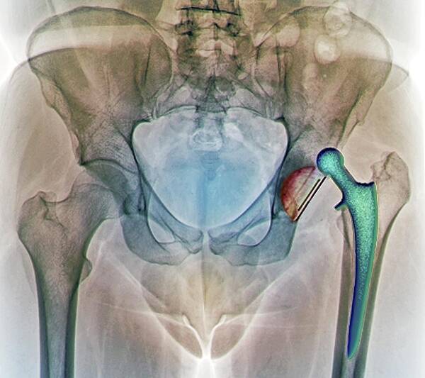 Artificial Poster featuring the photograph Dislocated Hip Replacement, X-ray by Zephyr
