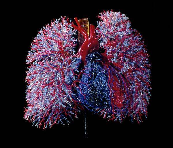 Human Body Poster featuring the photograph Human Heart And Lung Blood Vessels by Clouds Hill Imaging Ltd