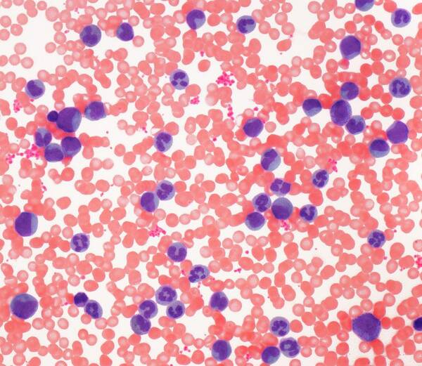 Blood Smear Poster featuring the photograph Leukaemia by Steve Gschmeissner