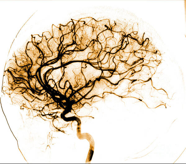 Catheter Cerebral Angiogram Poster featuring the photograph Cerebral Angiogram #4 by Medical Body Scans