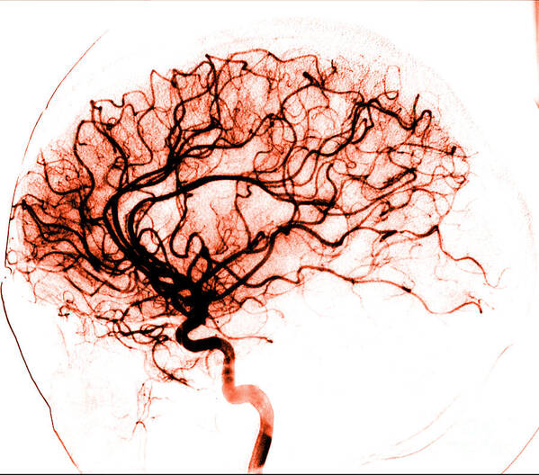 Catheter Cerebral Angiogram Poster featuring the photograph Cerebral Angiogram by Medical Body Scans
