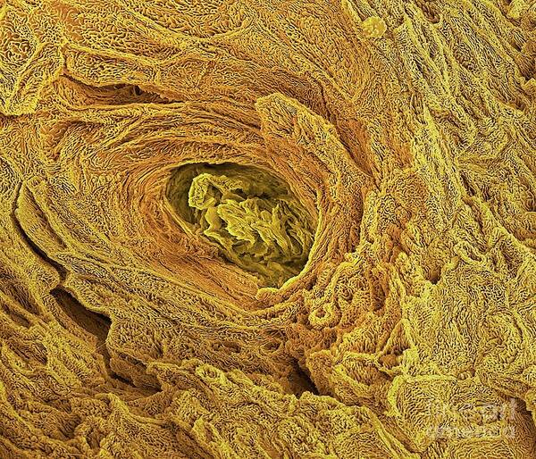 Spot Poster featuring the photograph Blocked Sweat Gland #1 by Steve Gschmeissner/science Photo Library