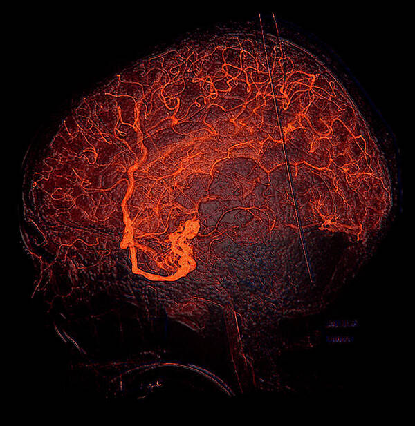 Abnormal Cerebral Arteriogram Poster featuring the photograph Enhanced Temporal Lobe Hemorrhage #1 by Living Art Enterprises, LLC